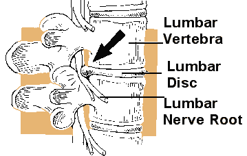 Diagram of the lumbar spine, labeling the lumbar vertebra, disc, and nerve root