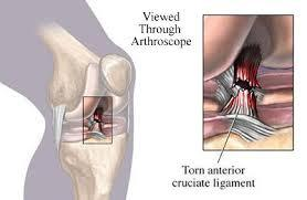 Medical diagram of a torn anterior cruciate ligament, viewed through an arthroscope